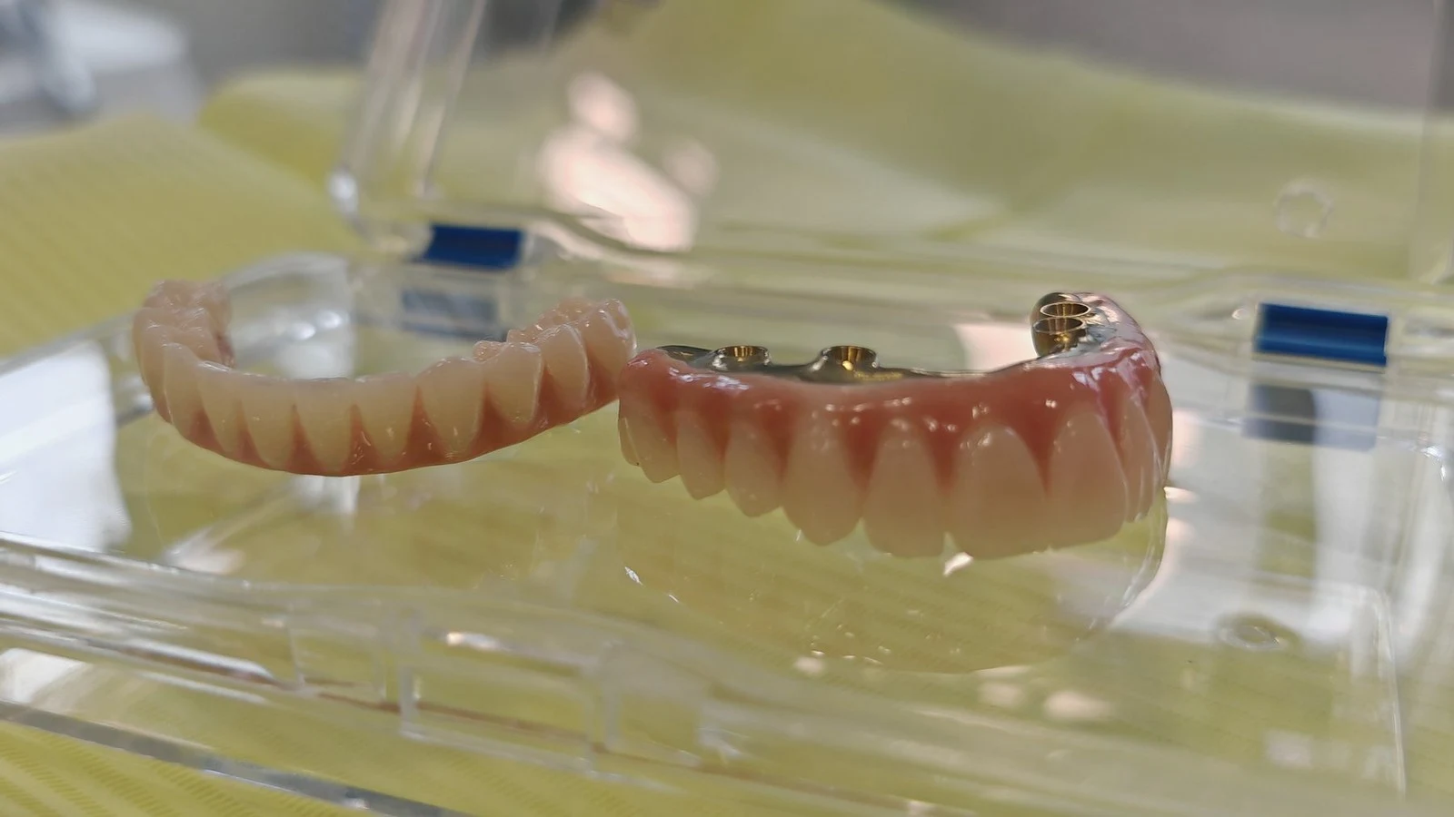 coroane-dentare-la-dental-chic-cluj-napoca-cand-devin-necesare-i-cum-se-aleg-materialele1